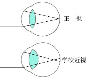 正視と学校近視の違い