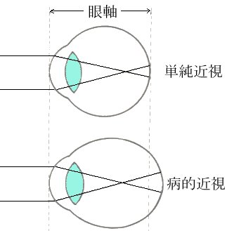 単純近視と病的近視