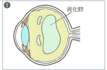 液化腔の様子
