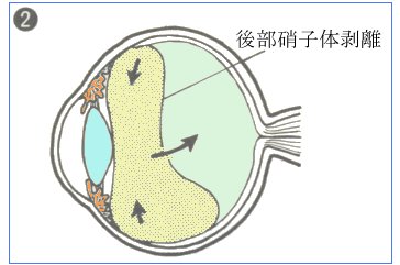 後部硝子体剥離がおこる様子