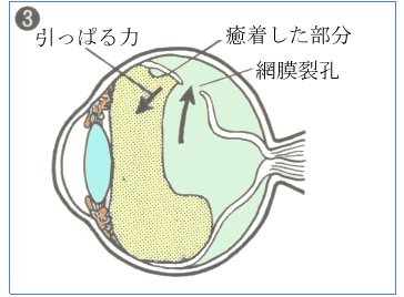 網膜剥離がおこる様子