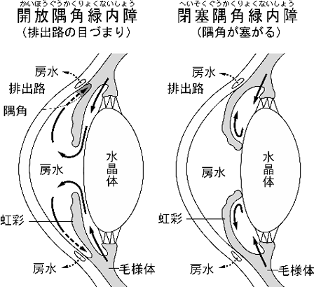 開放隅角緑内障・閉塞隅角緑内障