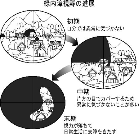 緑内障視野の進展は、初期は自分では異常に気づきません。さらに中期になっても異常に気づかないことが多いようです。末期になって初めて、視力が落ちて日常生活に支障をきたすようになります。