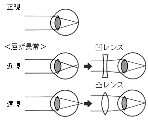 近視では中央の薄い凹レンズを、遠視では中央の厚い凸レンズを通してものを見ると、ピントが合う位置が調整されよく見えるようになります。