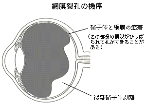 網膜裂孔の機序説明図