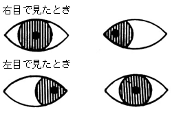 内斜視の場合、右目で見るときと左目で見るときでは、黒目が同じ方向に動きません。