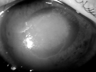 アカントアメーバによる角膜感染の写真