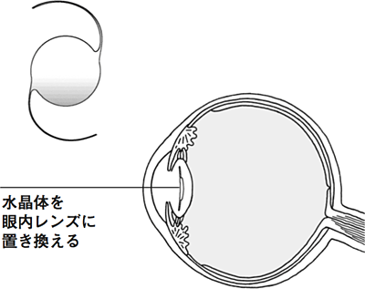 水晶体を眼内レンズに置き換える