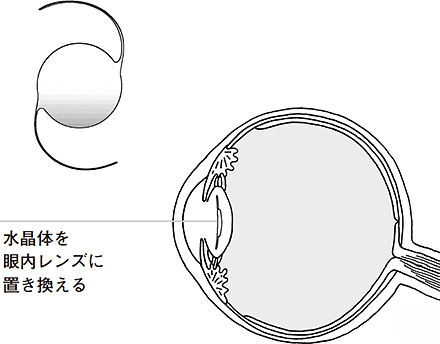 4 手術後の見え方と眼内レンズ 白内障手術を受ける方へ 知っておきたい白内障術後のケア 目についての健康情報 公益社団法人 日本眼科医会