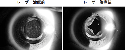 10 術後の合併症は 何に気をつければよいですか 白内障手術を受ける方へ 知っておきたい白内障術後のケア 目についての健康情報 公益社団法人 日本眼科医会