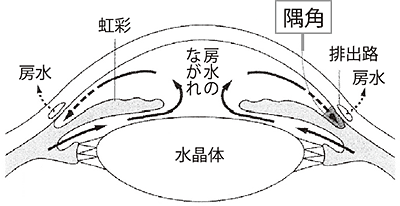 角 隅 緑内障 閉塞 急性