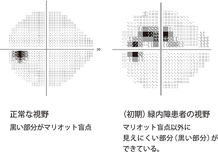 10 視野の検査 よくわかる緑内障 診断と治療 目についての健康情報 公益社団法人 日本眼科医会