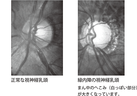 緑内障の視神経乳頭はまん中のへこみが大きくなります