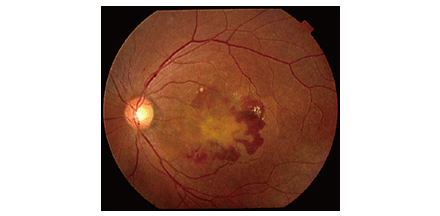 黄斑変性症の早期警告兆候