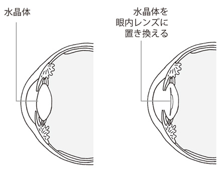 4 眼内レンズの働き 白内障手術と眼内レンズ 眼内レンズを上手に選ぶために 目についての健康情報 公益社団法人 日本眼科医会 4 眼内レンズの働き 白内障手術と眼内レンズ 眼内レンズを上手に選ぶために 目についての健康情報 公益社団法人 日本眼科医会