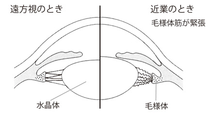 7 単焦点眼内レンズと多焦点眼内レンズ 白内障手術と眼内レンズ 眼内レンズを上手に選ぶために 目についての健康情報 公益社団法人 日本眼科医会 7 単焦点眼内レンズと多焦点眼内レンズ 白内障手術と眼内レンズ 眼内レンズを上手に選ぶために 目についての健康情報 公益社団法人 日本眼科医会