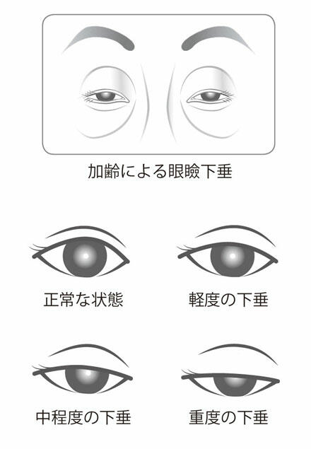 4 大人になってからなる眼瞼下垂 眼瞼下垂に悩むかたへ 目についての健康情報 公益社団法人 日本眼科医会