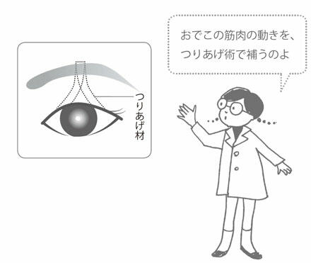 7 眼瞼下垂の手術 2 つりあげ術 眼瞼下垂に悩むかたへ 目についての健康情報 公益社団法人 日本眼科医会 7 眼瞼下垂の手術 2 つりあげ術 眼瞼下垂に悩むかたへ 目についての健康情報 公益社団法人 日本眼科医会