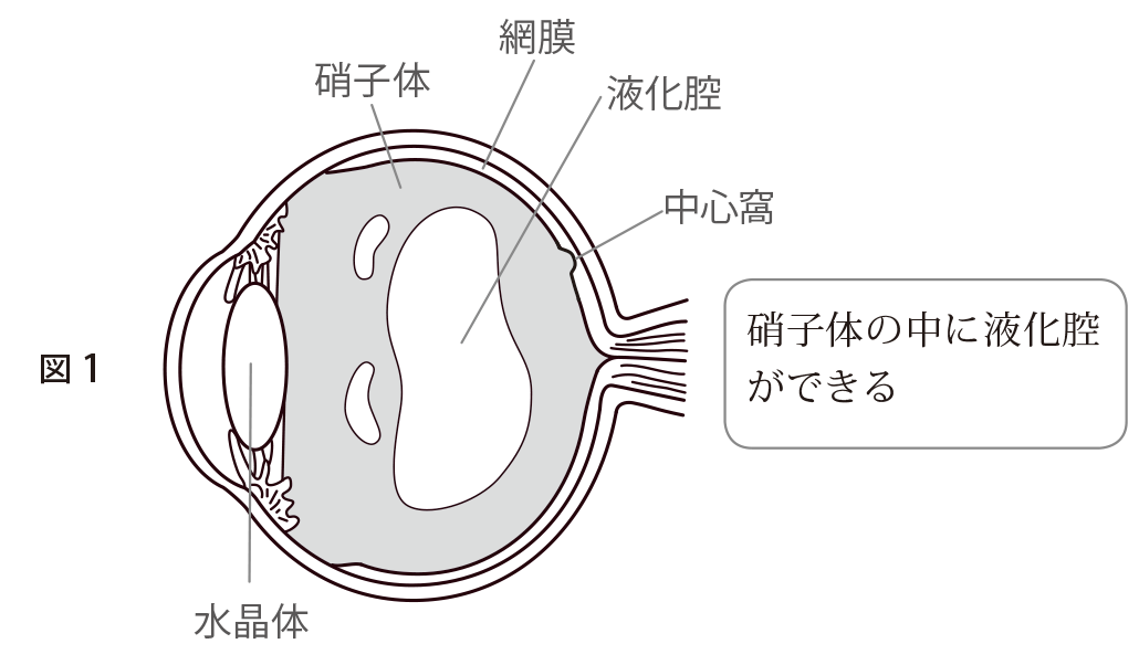 4 黄斑前膜は どのように発生するのか 40 歳を過ぎたなら知っておきたい黄斑前膜 診断と治療 目についての健康情報 公益社団法人 日本眼科医会 4 黄斑前膜は どのように発生するのか 40 歳を過ぎたなら知っておきたい黄斑前膜 診断と治療 目についての健康情報 公益社団法人 日本眼科医会