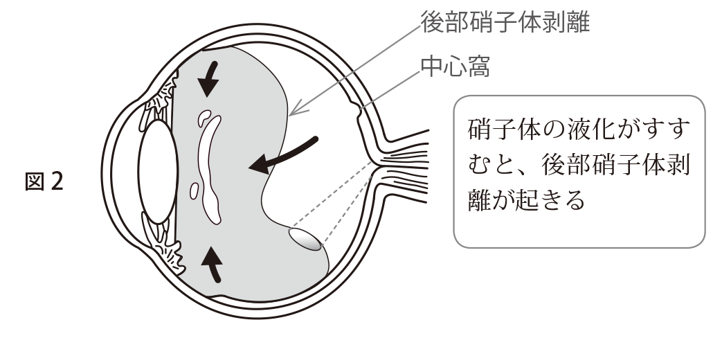 図2 硝子体の液化がすすむと、後部硝子体剥離が起きる