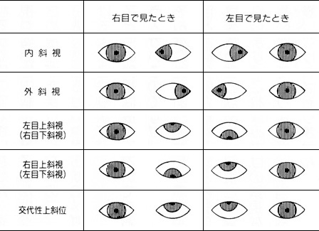 内 斜視