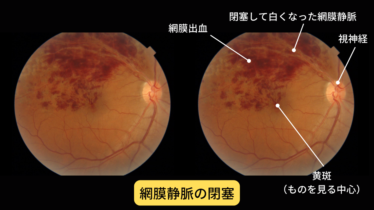 眼底 白斑 と は